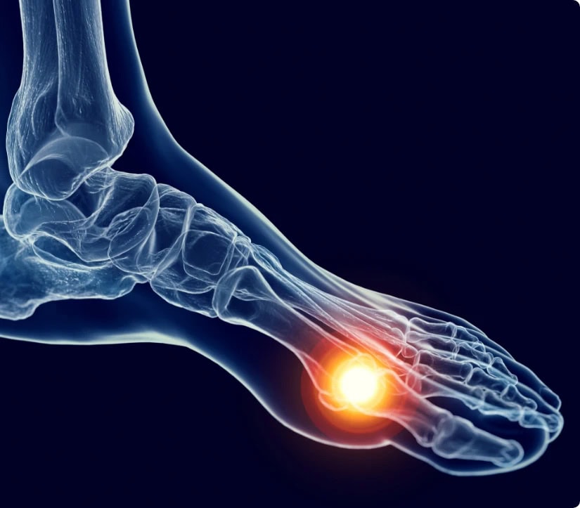 X-ray eines Fußes mit hervorgehobenem Schmerzpunkt im Bereich der Zehen.